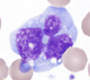 Fig 1J PB dysplastic monocyte